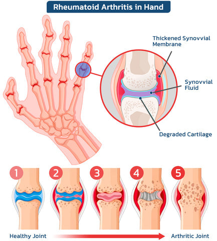 🐝 Seurico™ New Zealand Bee Venom Joint Relief Gel(New Zealand Bee Extract - Specializes in the treatment of orthopedic conditions and arthritic pain)